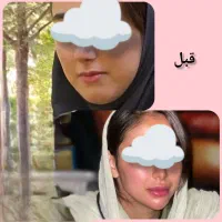 تزریق انواع فیلر بوتاکس نخ