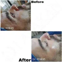 آموزش فیشال و پاکسازی پوست ویژه سال جدید|خدمات آموزشی|خوی, |دیوار