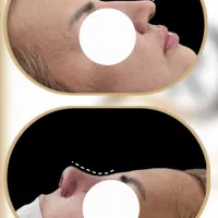 ساکشن غبغب جراحی زیبایی پلک و عمل سرپایی بینی|خدمات زیبایی و سلامت|تبریز, |دیوار