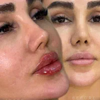 بوتاکس وفیلر صورت و بدن|خدمات آرایشگری و زیبایی|بیرجند, |دیوار