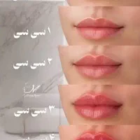 جشنواره تزریق ژل بوتاکس فیلر پی آرپی مطب زیبایی|خدمات آرایشگری و زیبایی|تبریز, |دیوار