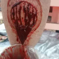 حجامت و زالو درمانی