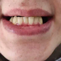 دندان سازی پروتز متحرک|خدمات آرایشگری و زیبایی|کرج, شاهین‌ویلا|دیوار