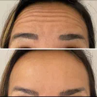 ژل و بوتاکس مزوژل مزو تخفیف ویژه تا پایان شهریور|خدمات آرایشگری و زیبایی|مشهد, فلسطین|دیوار