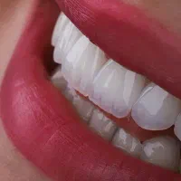 دندانپزشکی تبریز ایمپلنت ارتودنسی لمینت روکش