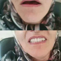 تخفیفات وشرایط اقساطی برای ایمپلنت و پروتز مصنوعی|خدمات آرایشگری و زیبایی|بجنورد, |دیوار