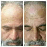 درمان پیسی / پسوریازیس/ مشکلات پوستی و ایمنی|آرایشی، بهداشتی، درمانی|مشهد, شهرک رازی (شهرک غرب)|دیوار