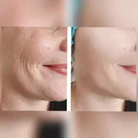 تزریق مزوژل پروفایلو لیبل دار