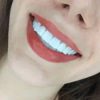کامپوزیت دندان ( طرح لبخند )|خدمات آرایشگری و زیبایی|یاسوج, |دیوار