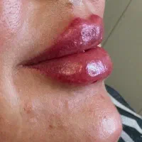 مدل برای فیلر لب و بوتاکس|خدمات آرایشگری و زیبایی|کرمانشاه, |دیوار