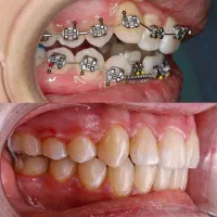 ارتودنسی ثابت و متحرک با اقساط بلند مدت|خدمات آرایشگری و زیبایی|میانه, |دیوار