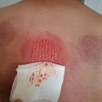 انواع فصد و انواع حجامت های تخصصی|خدمات آرایشگری و زیبایی|قم, کیوانفر|دیوار