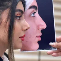 دکتر عمل بینی/لیفت/ترمیم