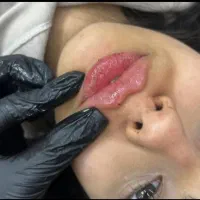 ژل و بوتاکس