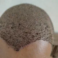 کاشت مو،ریش ،سیبیل،ابرو،پی آرپی ومزوتراپی|خدمات آرایشگری و زیبایی|بوشهر, |دیوار