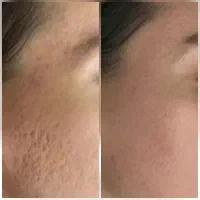 مدل فیشیال وی ای پی و درمان جوش|خدمات آرایشگری و زیبایی|تهران, مجیدیه|دیوار