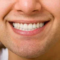 دندان مصنوعی، دندانسازی، دندان طرح لمینت 40%تخفیف|آرایشی، بهداشتی، درمانی|مشهد, مصلی (کارمندان اول)|دیوار