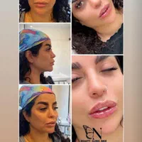 تزریق ژل و بوتاکس مطب