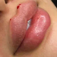 ژل لب و فیلر مدلینگ فیس