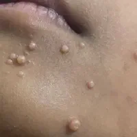 فریز زگیل ( بالوکە )|خدمات آرایشگری و زیبایی|بوکان, |دیوار