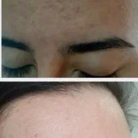 مشتری لارج میخام پوست منافذ لک اسکار چروک
