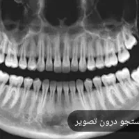 کامپوزیت ،دندان مصنوعی .روکش دندان