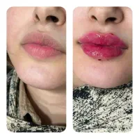 خدمات ژل و بوتاکس ولیزر و فیشیال و...|خدمات آرایشگری و زیبایی|اهواز, پادادشهر|دیوار
