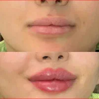 لیزر مو زائد، فشیال،پی آر پی،ژل و بوتاکس توسط پزشک|خدمات آرایشگری و زیبایی|مراغه, |دیوار