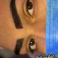 کاشت ابرو با تراکم و خواب عالی