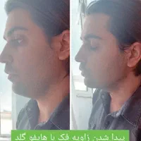 لیپوساکشن شکم و پهلو،ترنسفر به باسن،هایفودابلوگولد|خدمات آرایشگری و زیبایی|اصفهان, دشتستان|دیوار