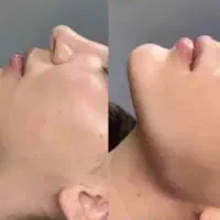 جشنواره تزریق ژل و انواع بوتاکس