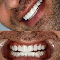 کامپوزیت دندان|خدمات آرایشگری و زیبایی|آبادان, |دیوار