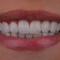 ایمپلنت دندان فقط از 6900 قسطی 6 تا 24 ماه|خدمات آرایشگری و زیبایی|تهران, میرداماد|دیوار