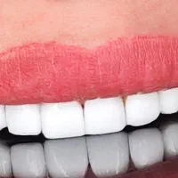 کامپوزیت و لمینت اقساطی دندانپزشکی بدون پیش پرداخت