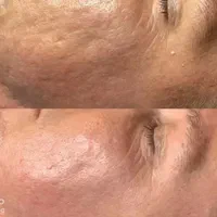 تزریق مزوژل روشن‌کننده جوانساز وبوتاکس|خدمات آرایشگری و زیبایی|آبادان, |دیوار