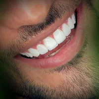 کامپوزیت، لمینت، ایمپلنت اقساط ویژه|خدمات آرایشگری و زیبایی|فولادشهر, B5|دیوار