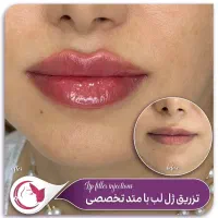 جشنواره تخفیفات 50% فیلر لب زیر چشم شقیقه دکترمقدم|خدمات آرایشگری و زیبایی|مشهد, هفت تیر (آب و برق)|دیوار