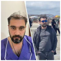 کاشت مو با شرایط ویژه نقد و اقساط