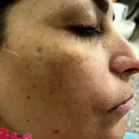 همه لکا و کک و مک هاتو نابود کن