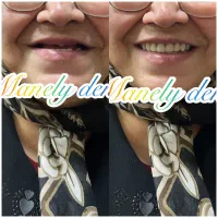 دندان مصنوعی ۲۰٪تخفیف|آرایشی، بهداشتی، درمانی|آمل, |دیوار