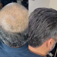 انواع پروتز مو فقط اورجینال وارداتی(نقد و اقساط)|آرایشی، بهداشتی، درمانی|تهران, فردوس|دیوار