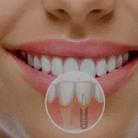 ایمپلنت کره ای با روکش دیجیتال