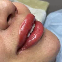 میکروبلیدینگ .فیبروز،شیدینگ لب ،تخفیف عیدانه