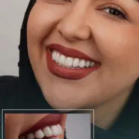 ایمپلنت لمینت کامپوزیت ارتودنسی روکش|خدمات زیبایی و سلامت|مشهد, سجاد شهر|دیوار