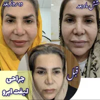 جراحی های زیبایی لیفت شقیقه ابرو صورت غبغب پلک
