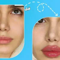تزریق ژل و بوتاکس و لیزر موهای زائد|خدمات آرایشگری و زیبایی|شیراز, آزادگان|دیوار