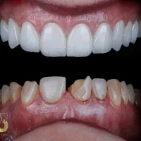 شرایط استثنایی ویژه ایمپلنت، لمینیت،اوردنچر،مصنوعی|خدمات آرایشگری و زیبایی|تهران, مجیدیه|دیوار