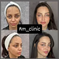 ۵۰ درصد تخفیف تزریق صورت سبک عربی هالیوودی لب روسی|خدمات آرایشگری و زیبایی|ری, دیلمان|دیوار