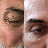 هایفو تراپی