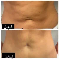 دستگاه جوانساز هایفو صورت و بدن|آرایشگاه و سالنهای زیبایی|اهر, |دیوار